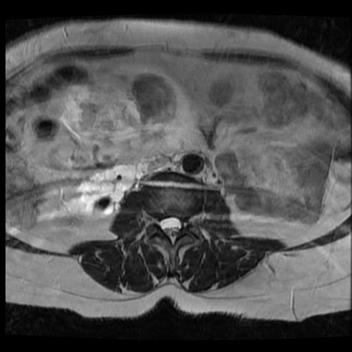File:Atypical retroperitoneal lymphocoeles with large leiomyoma of uterus (Radiopaedia 32084-33027 Axial T2 2).jpg