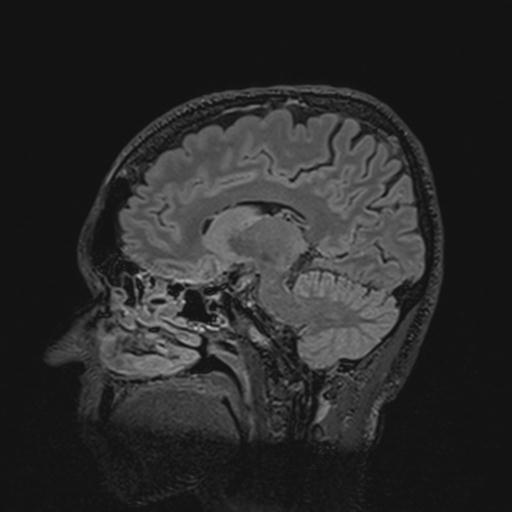 Autoimmune limbic encephalitis (Radiopaedia 30363-31005 Sagittal FLAIR 70).jpg