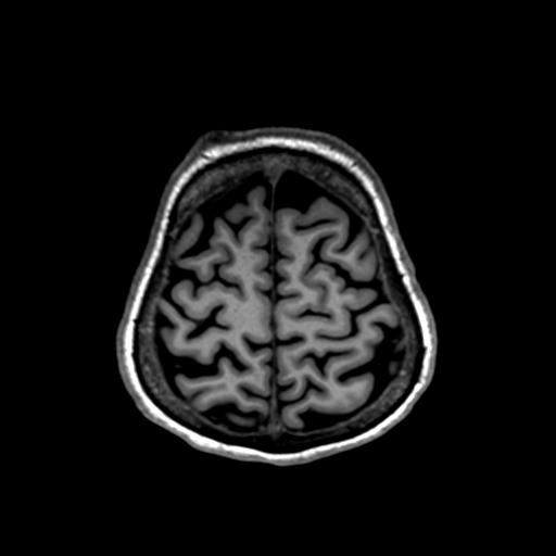 Autoimmune limbic encephalitis (Radiopaedia 30363-31005 T1 Axial 1mm 127).jpg