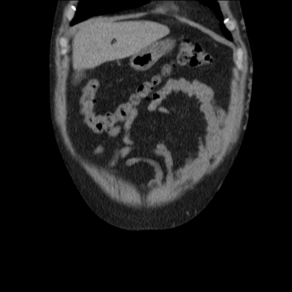 File:Autosomal dominant polycystic kidney disease (Radiopaedia 36539-38101 C 13).jpg