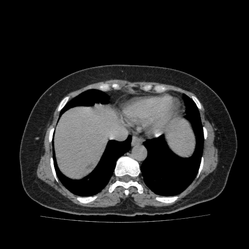 Autosomal dominant polycystic kidney disease (Radiopaedia 38189-40194 Axial C+ delayed 1).jpg