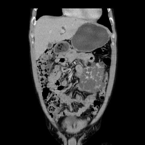 Autosomal dominant polycystic kidney disease (Radiopaedia 66349-75582 A 14).jpg