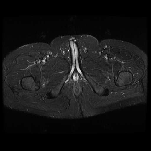 File:Avascular necrosis of the hip (Radiopaedia 61503-69465 Axial STIR 26).jpg