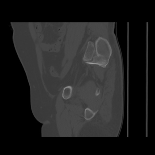 Avascular necrosis of the hip (Radiopaedia 61503-69467 B 40).jpg