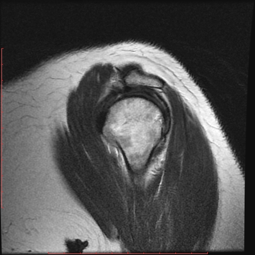 File:Avulsion fracture - greater tuberosity of humerus (Radiopaedia 25457-25703 Sagittal T2 8).jpg