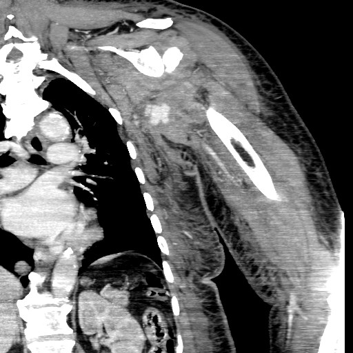 File:Axillary arterial pseudoaneurysm (Radiopaedia 24925-25195 B 11).jpg