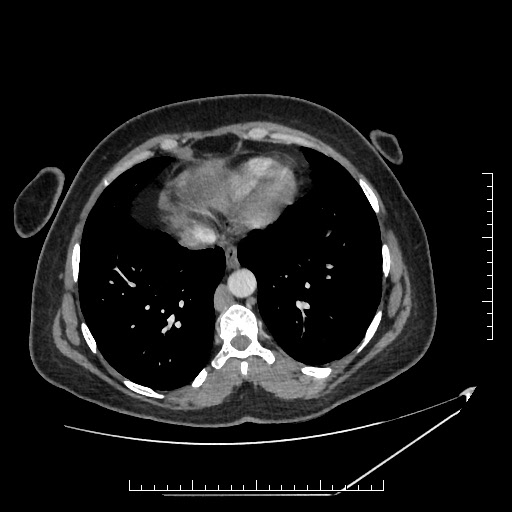 File:Azygos continuation of the IVC (Radiopaedia 40416-42965 A 2).jpg