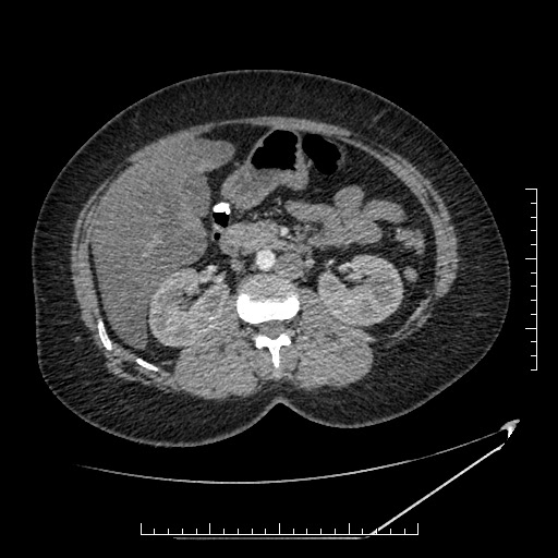 File:Azygos continuation of the IVC (Radiopaedia 40416-42965 A 35).jpg
