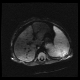 B cell lymphoma (Radiopaedia 56281-62954 Axial DWI 15).jpg