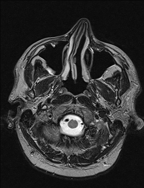 File:Balo concentric sclerosis (Radiopaedia 50458-55940 Axial T2 42).jpg