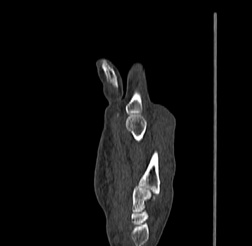 Base of 2nd metacarpal fracture (Radiopaedia 73741-84544 Sagittal bone window 46).jpg