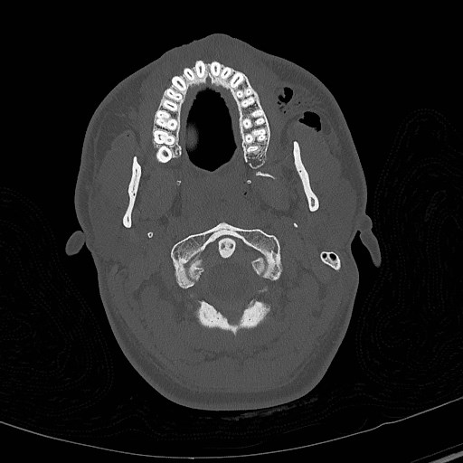 Base of skull fracture with bilateral Le Fort fractures (Radiopaedia 47094-51638 Axial bone window 13).jpg
