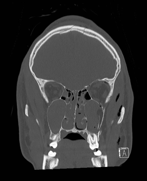 Base of skull fracture with bilateral Le Fort fractures (Radiopaedia 47094-51638 Coronal bone window 71).jpg
