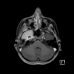 Base of skull rhabdomyosarcoma (Radiopaedia 32196-33142 T1 C+ fat sat 30).jpg