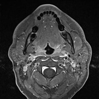 File:Base of tongue squamous cell carcinoma (Radiopaedia 31174-31884 Axial T1 C+ fat sat 22).jpg