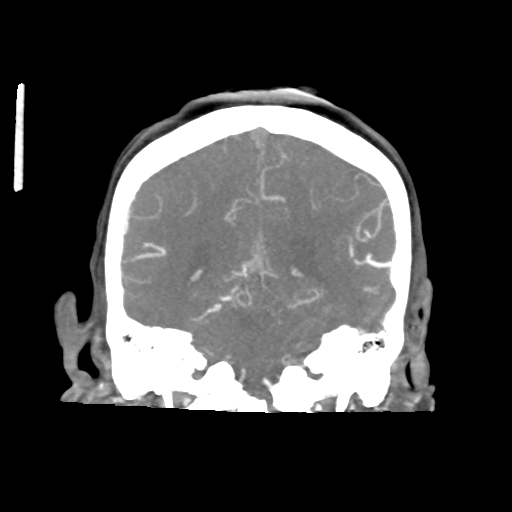 Basilar and bilateral vertebral artery occlusion (Radiopaedia 45592-49723 B 66).png