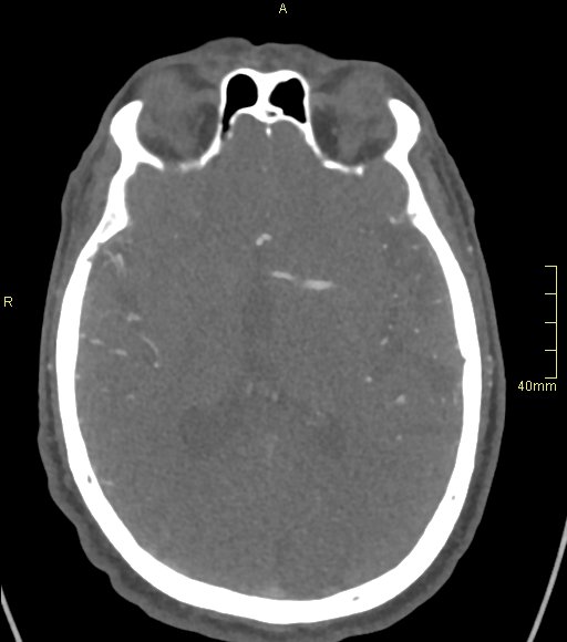 Basilar artery aneurysm (Radiopaedia 56261-62932 A 84).jpg