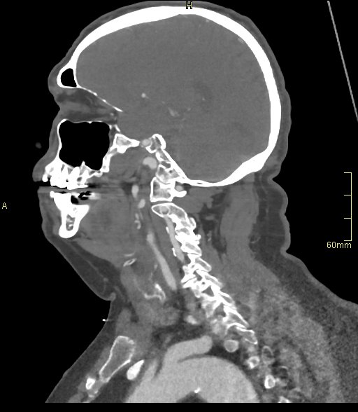 File:Basilar artery aneurysm (Radiopaedia 56261-62932 C 43).jpg