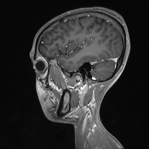 Basilar artery perforator aneurysm (Radiopaedia 82455-97733 G 115).jpg