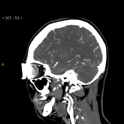 Basilar artery thrombosis (Radiopaedia 16260-15944 C 47).jpg