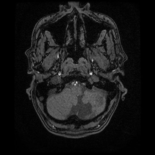 Basilar top and left middle cerebral artery aneurysm (Radiopaedia 61965-70031 Axial MRA 6).jpg