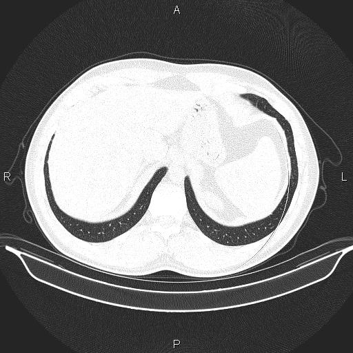 File:Beam hardening and ring artifacts (Radiopaedia 85323-100915 Axial lung window 68).jpg