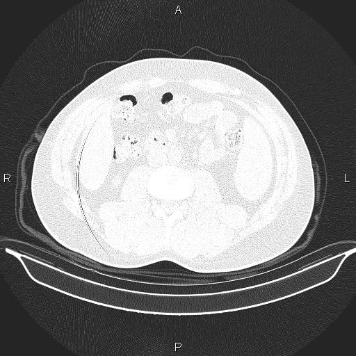 File:Beam hardening and ring artifacts (Radiopaedia 85323-100915 Axial lung window 93).jpg