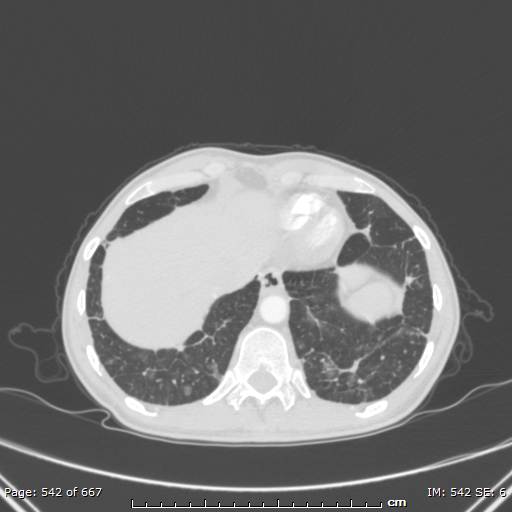 File:Behçet disease (Radiopaedia 44247-47889 Axial lung window 75).jpg