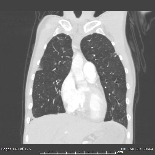 Behçet disease (Radiopaedia 44247-47889 Coronal lung window 45).jpg
