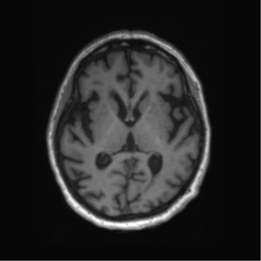 Behavioral variant frontotemporal dementia and late onset schizophrenia (Radiopaedia 52197-58083 Axial T1 50).png