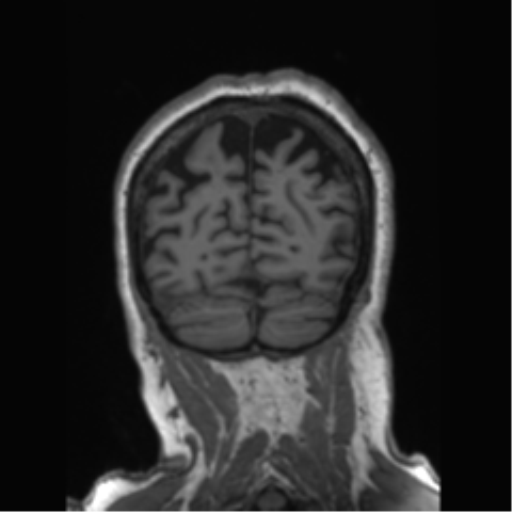 Behavioral variant frontotemporal dementia and late onset schizophrenia (Radiopaedia 52197-58083 Coronal T1 24).png