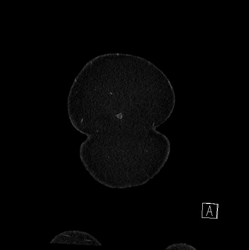 Below filter IVC thrombosis (Radiopaedia 58187-65266 B 12).jpg