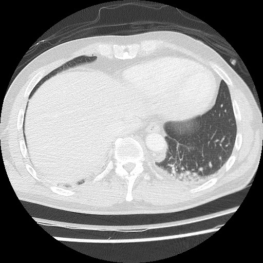 Benign post-traumatic pseudopneumoperitoneum (Radiopaedia 71199-81495 Axial lung window 57).jpg