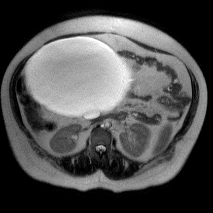 File:Benign seromucinous cystadenoma of the ovary (Radiopaedia 71065-81300 Axial T2 8).jpg