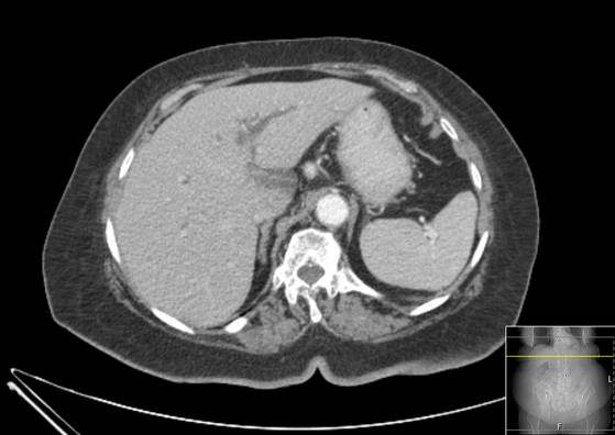 Bicameral celiacomesenteric aneurysm (Radiopaedia 55766-62327 A 12).jpg