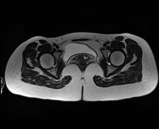 File:Bicornuate bicollis uterus (Radiopaedia 61626-69616 Axial T2 30).jpg