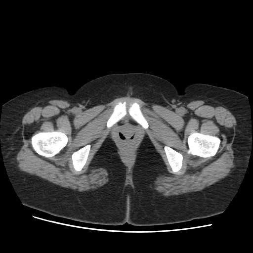 File:Bicornuate uterus- on MRI (Radiopaedia 49206-54296 Axial non-contrast 16).jpg