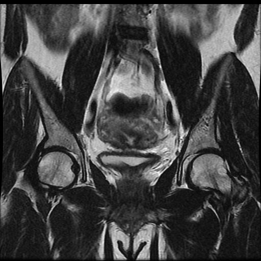 File:Bicornuate uterus (Radiopaedia 51676-57472 Coronal T2 13).jpg