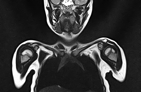 File:Bilateral Sprengel deformity with Klippel-Feil syndrome (Radiopaedia 66395-75650 Coronal T2 6).jpg