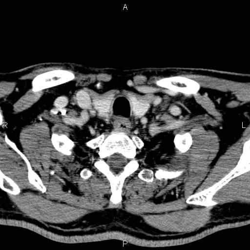 Bilateral Warthin tumors (Radiopaedia 84034-99263 Axial With contrast 60).jpg