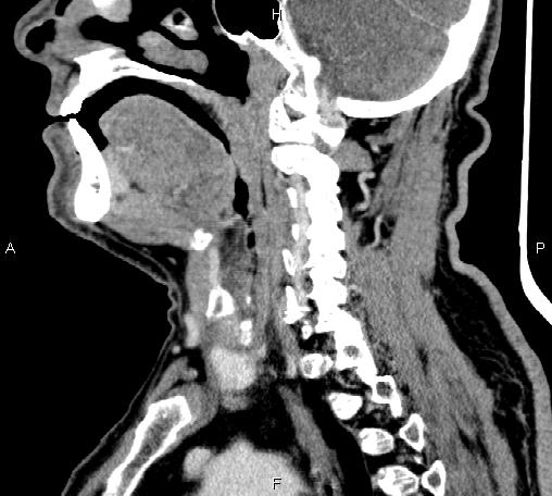 Bilateral Warthin tumors (Radiopaedia 84034-99263 D 46).jpg