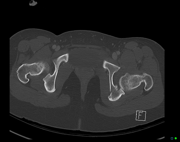 Bilateral acetabular fractures (Radiopaedia 79272-92308 Axial bone window 52).jpg