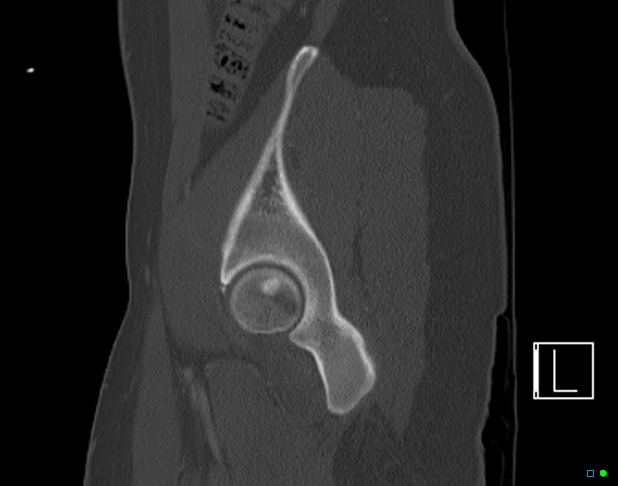 File:Bilateral acetabular fractures (Radiopaedia 79272-92308 Sagittal bone window 20).jpg