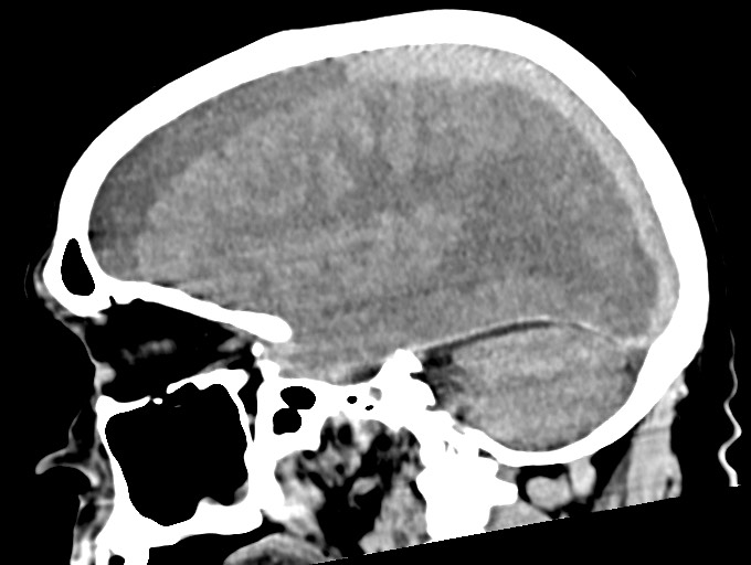 Bilateral acute on chronic subdural hematomas (Radiopaedia 78466-91146 C 38).jpg