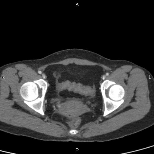Bilateral adrenal gland hyperenhancement in pancreatitis (Radiopaedia 86642-102753 E 103).jpg
