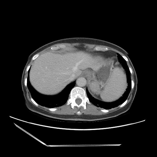 Bilateral adrenal granulocytic sarcomas (chloromas) (Radiopaedia 78375-91007 A 21).jpg