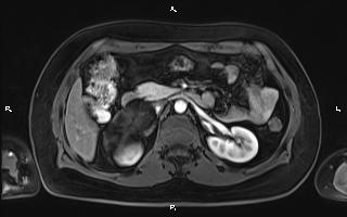 File:Bilateral adrenal myelolipoma (Radiopaedia 63058-71537 Axial T1 C+ fat sat 45).jpg