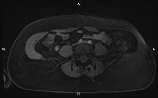Bilateral adrenal myelolipoma (Radiopaedia 63058-71537 Axial T1 C+ fat sat 77).jpg