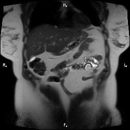 File:Bilateral adrenal myelolipoma (Radiopaedia 63058-71537 Coronal T2 26).jpg