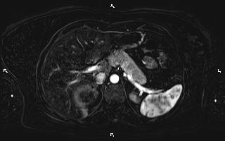 Bilateral adrenal myelolipoma (Radiopaedia 63058-71537 I 30).jpg